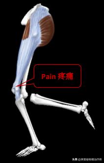 老生常谈跑步膝：髂胫束综合征（ITBS）