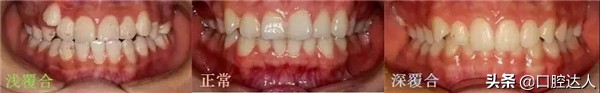 牙齿深覆合怎么判断严不严重,牙齿深覆合是什么样子