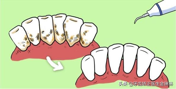 洗牙后觉得牙齿酸软是怎么回事,洗牙后牙齿一直酸软怎么改善