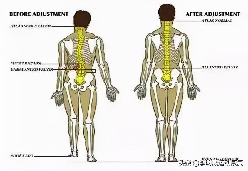 骨盆不正的危害动画视频,骨盆不正危害图片