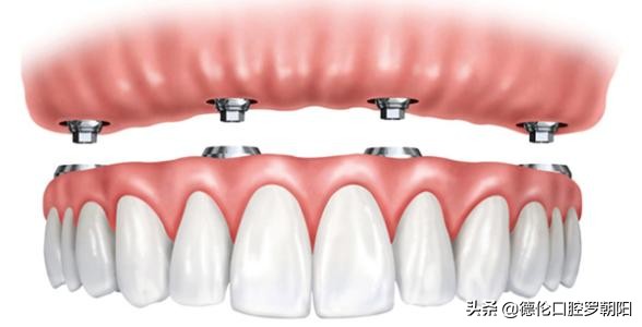 家里有老人牙齿掉光了，怎么办？