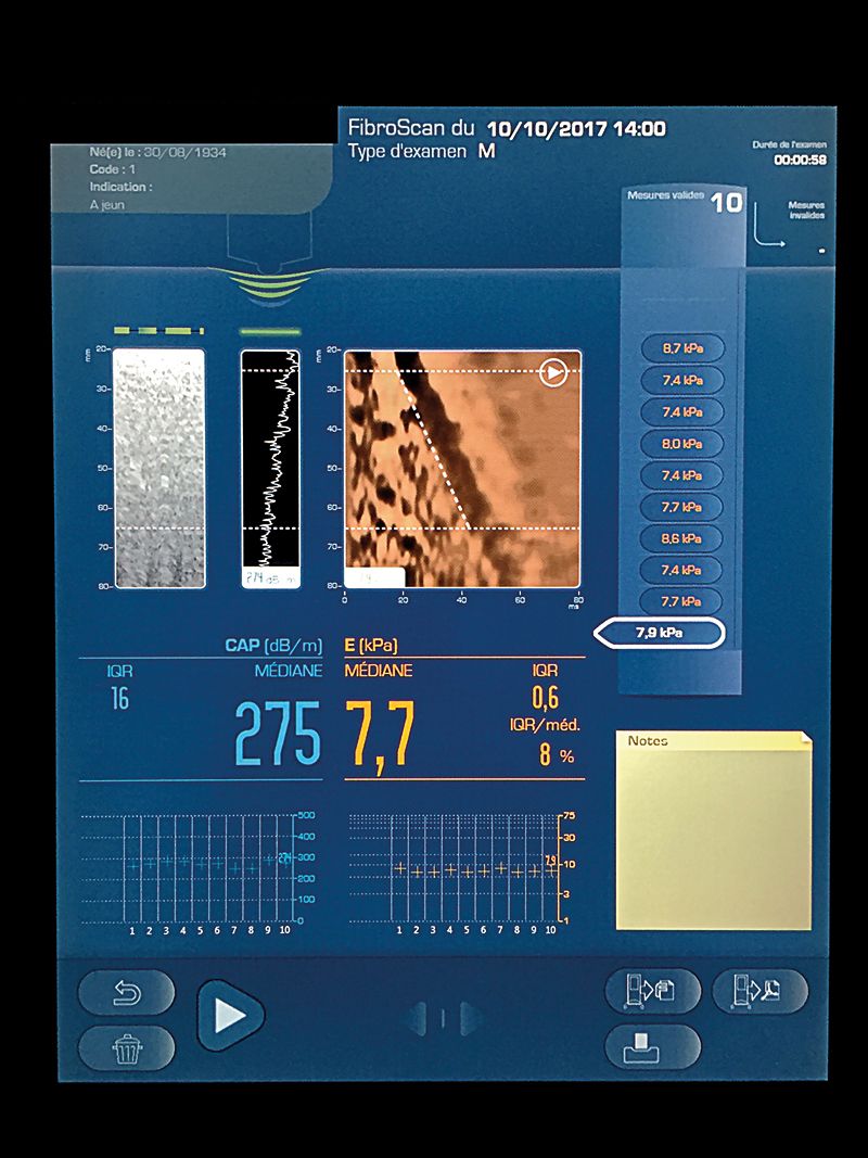 肝穿刺可以查到肝硬化的原因吗,肝穿刺能检查出肝硬化了吗