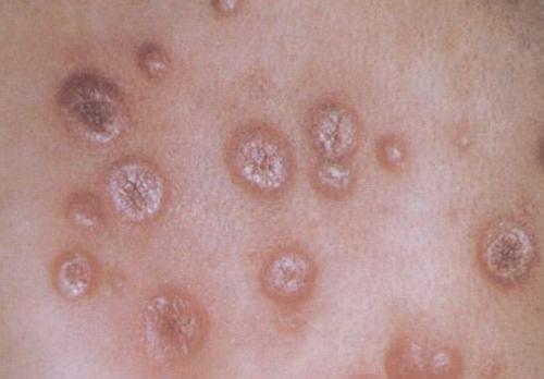 患有梅毒就是意味着有不洁*生活性**吗？还有这几个原因！