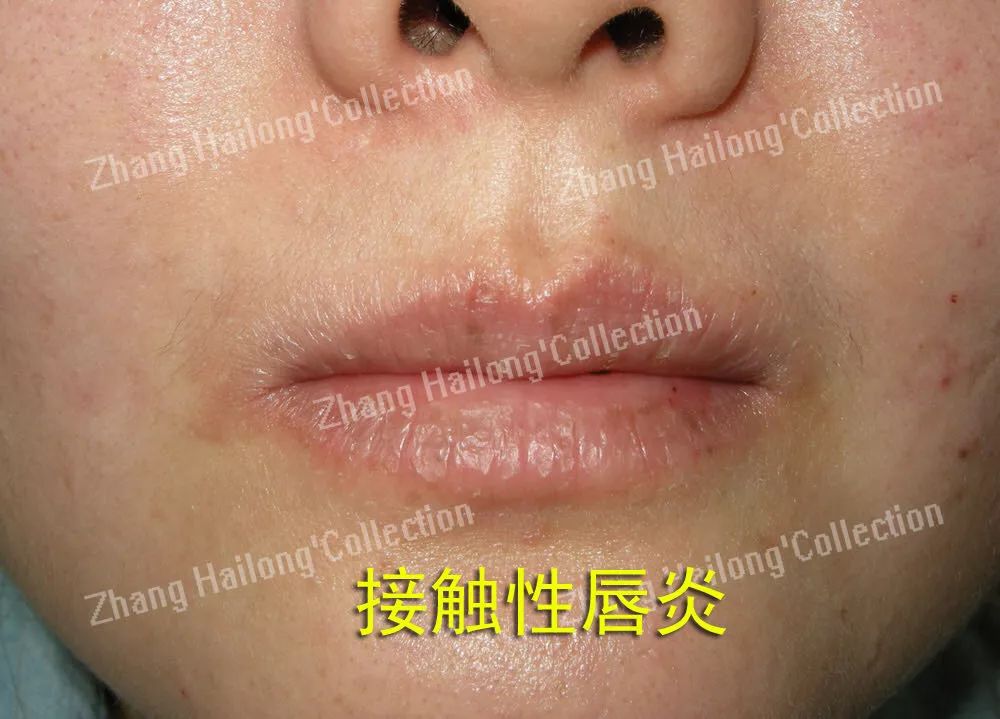 唇炎反复和口红有关系吗,都是红唇惹的祸