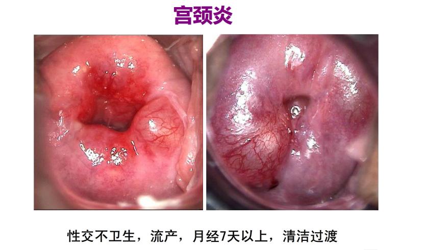 71岁女性筛查hpv高危是不是宫颈癌,男性hpv和哪些癌症有关