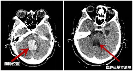 突发脑干出血机器人来救命
