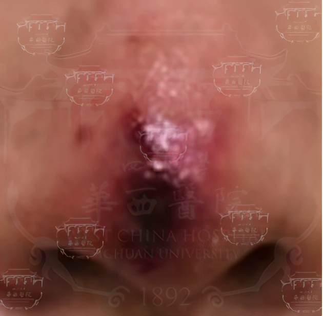 打玻尿酸多久可以移植自体脂肪,打玻尿酸整形有危险吗