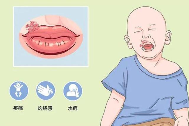 小孩单纯疱疹多久能好,儿童单纯疱疹严重吗