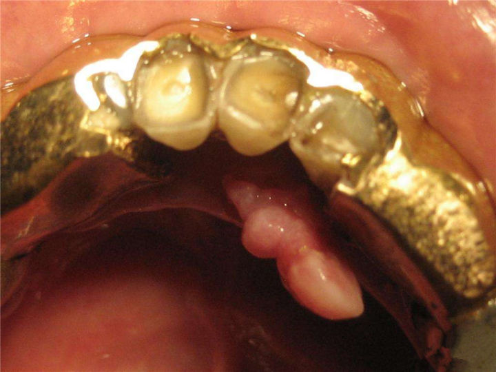 做一颗临时牙教程,自制隐形牙