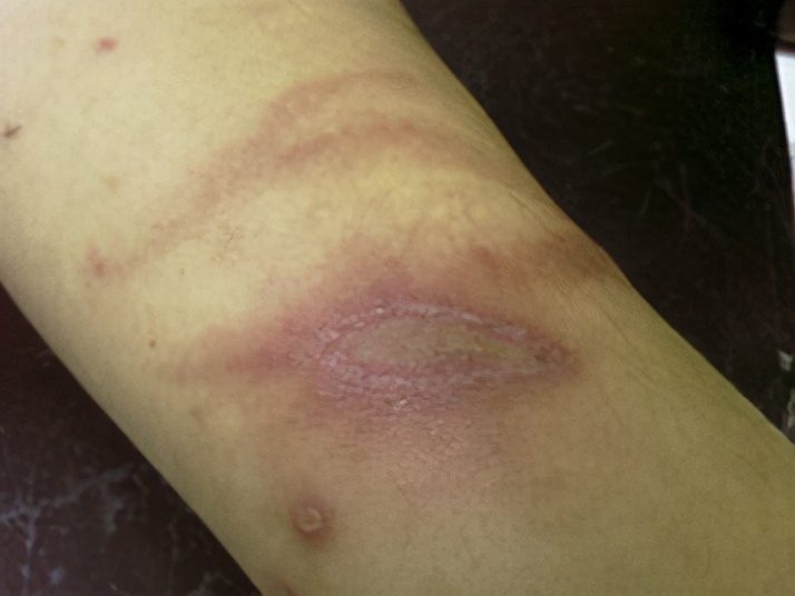 男孩被蚂蚁吓死,蚂蝗寄生在五岁男孩身体里一年