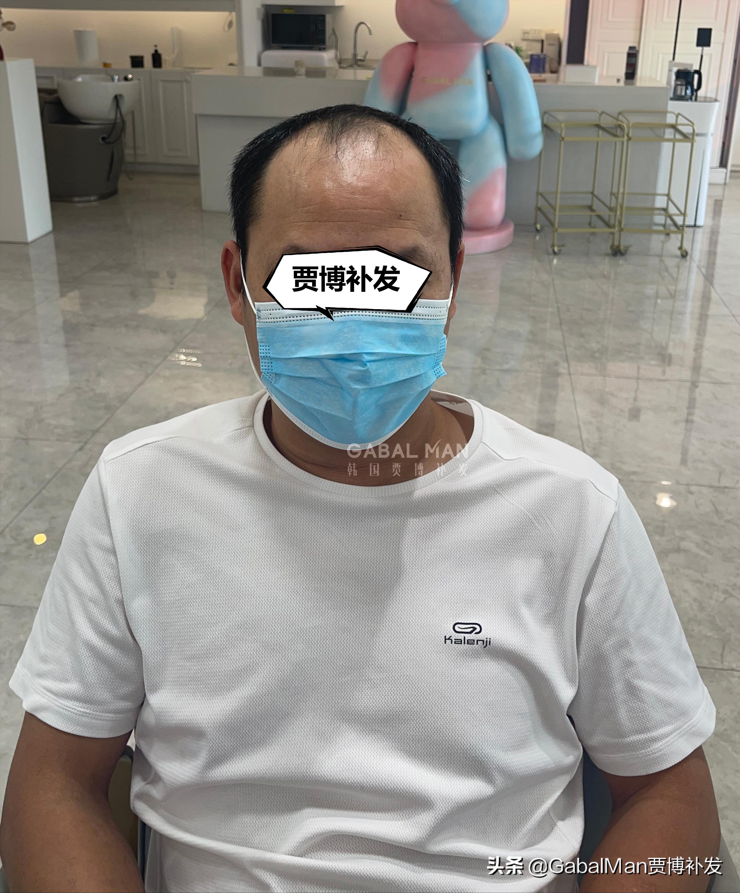 头顶脱发戴什么样的假发好,头顶脱发没有刘海用什么样的假发