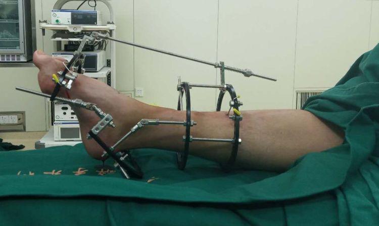 太原中心医院骨科汾东一病区完成首例ilizarov外固定矫形高弓足