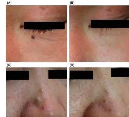 色素痣可以随意的祛除吗,无色素痣怎么去除