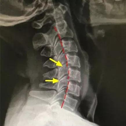 女子坐过山车扭伤颈椎,坐过山车扭伤脖子