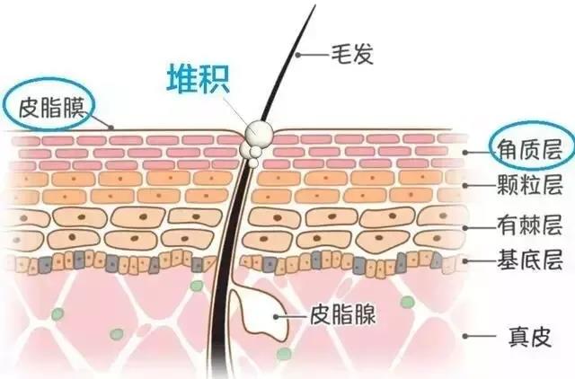 闭口应该怎么处理,闭口怎么办最有效的方法
