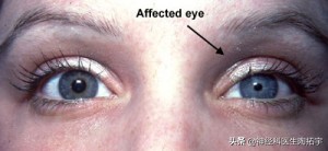 眼球人体解剖学讲解,眼睛解剖讲解