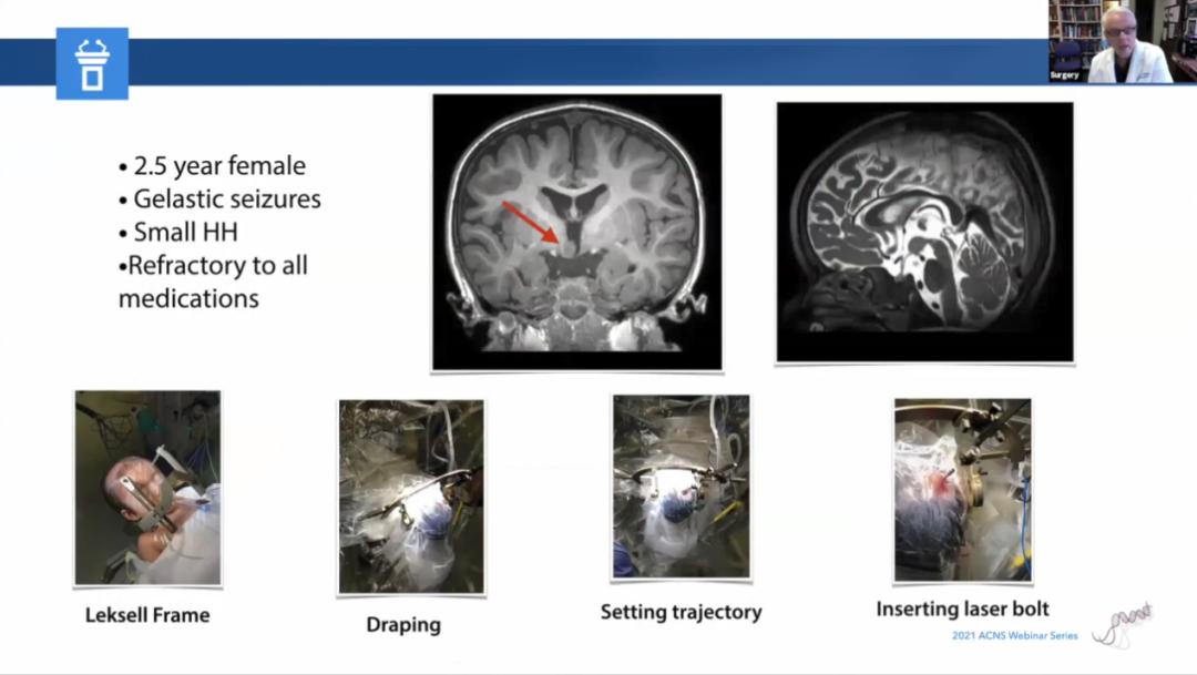 儿童癫痫治愈的真实案例,儿童难治性癫痫有哪些