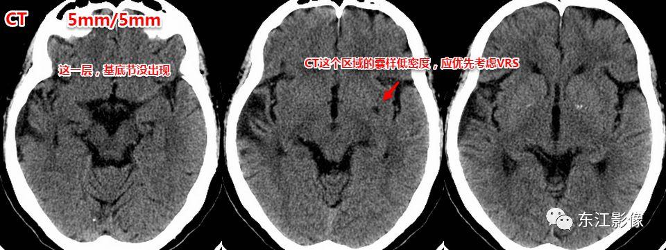 头颅mri扫描影像哪里找,头颅影像mra详细解说