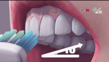 青少年整牙会出现黑三角吗,上牙有黑三角吗