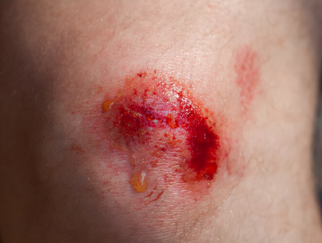 两块钱的红霉素软膏有什么用途,2块钱的红霉素软膏能祛斑吗