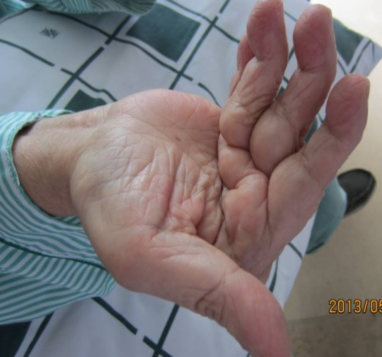 中医如何治疗类风湿关节炎,中医如何治疗类风湿滑膜炎