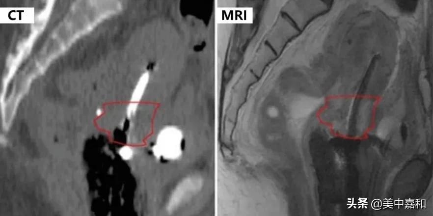 MRI引导的无痛后装治疗宫颈癌