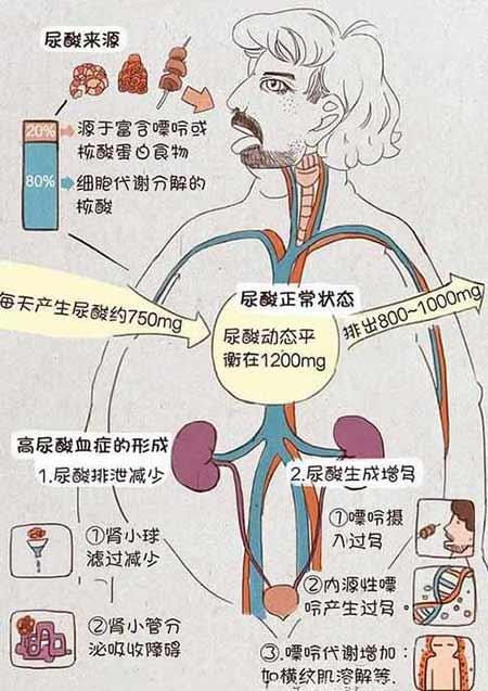 治痛风降尿酸记住这10点,运动排汗痛风