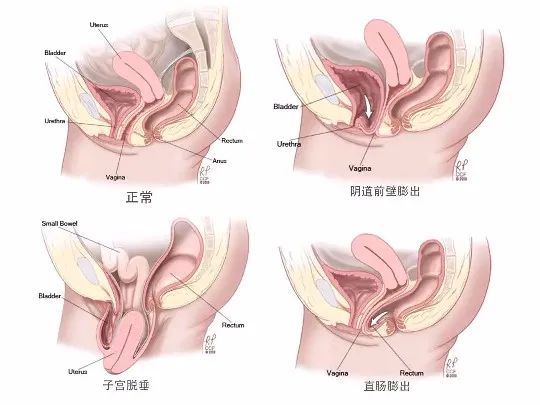 你便秘,你的便秘是怎么来的