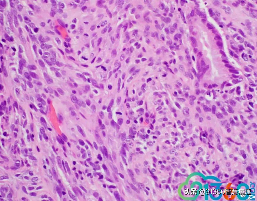 宫颈腺癌silvaa型用化疗吗,宫颈腺癌silvab型需要放疗几次