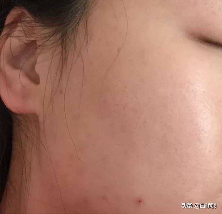 红肿硬块痘痘没有脓怎么快速消退,红肿痘痘不疼了但是还是有包