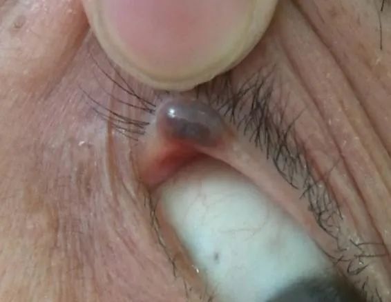 眼整形修复权威科普,科普眼整形手术是个什么手术多图