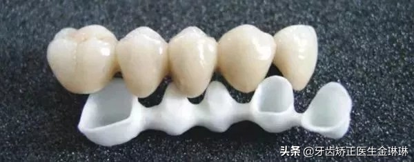 二氧化铬烤瓷牙和全瓷牙哪个好,烤瓷牙和全瓷牙的优缺点多少钱