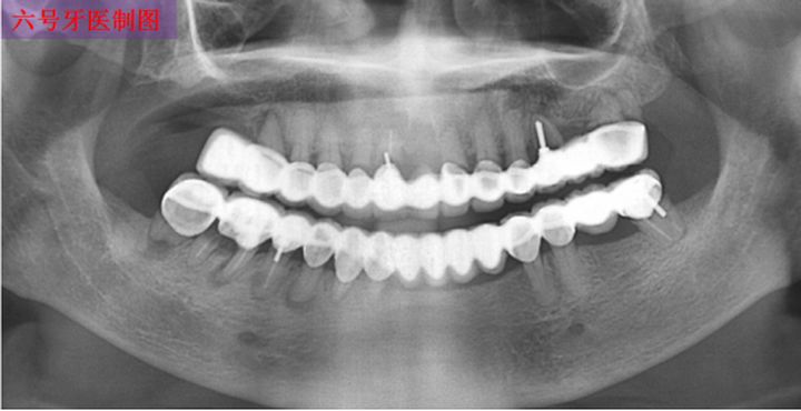 十八岁是矫正牙齿好还是烤瓷牙好,牙齿中线不齐能通过烤瓷牙修复吗