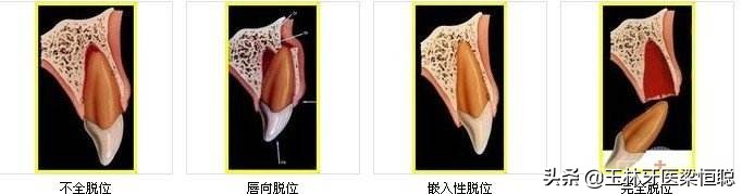 牙齿磕掉了怎么办幼儿园,6岁牙齿磕掉了怎么办