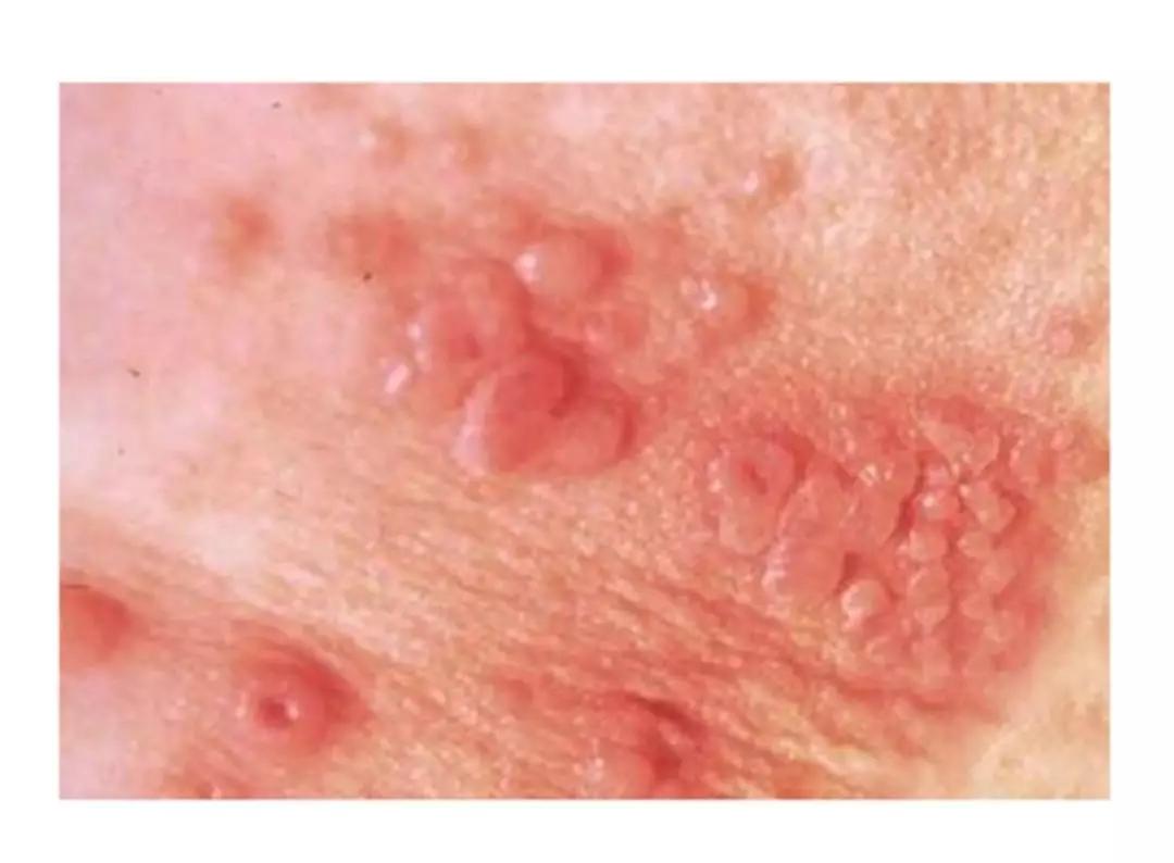 哪里长带状疱疹最危险,孕妇长疱疹咋办