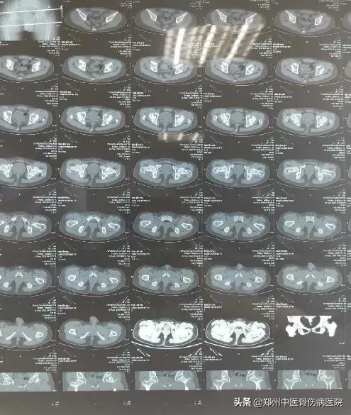 骨坏死中心疑难病例讨论:髋关节的剥脱性骨软骨炎的诊治