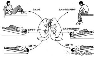 鱼腥草治支气管扩张,支气管扩张科普论文