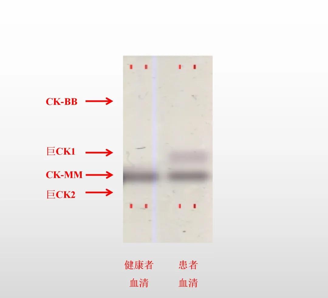 ck同工酶偏高怎么回事,肌酸激酶和肌酸激酶同工酶倒置