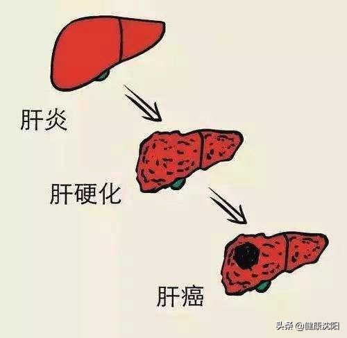 肝癌防治日,世界肝炎日聚焦肝癌治疗新手段