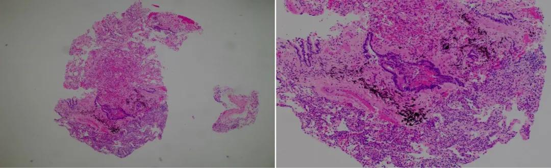 机化性肺炎必须病理确诊吗,机化性肺炎好转的征兆
