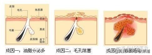 祛痘印效果最佳的产品是什么,祛痘印效果好的产品是什么