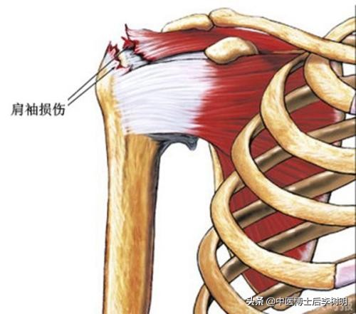 一招弄清你是肩膀痛还是肩周炎,老中医肩周炎肩膀疼一招立刻解决