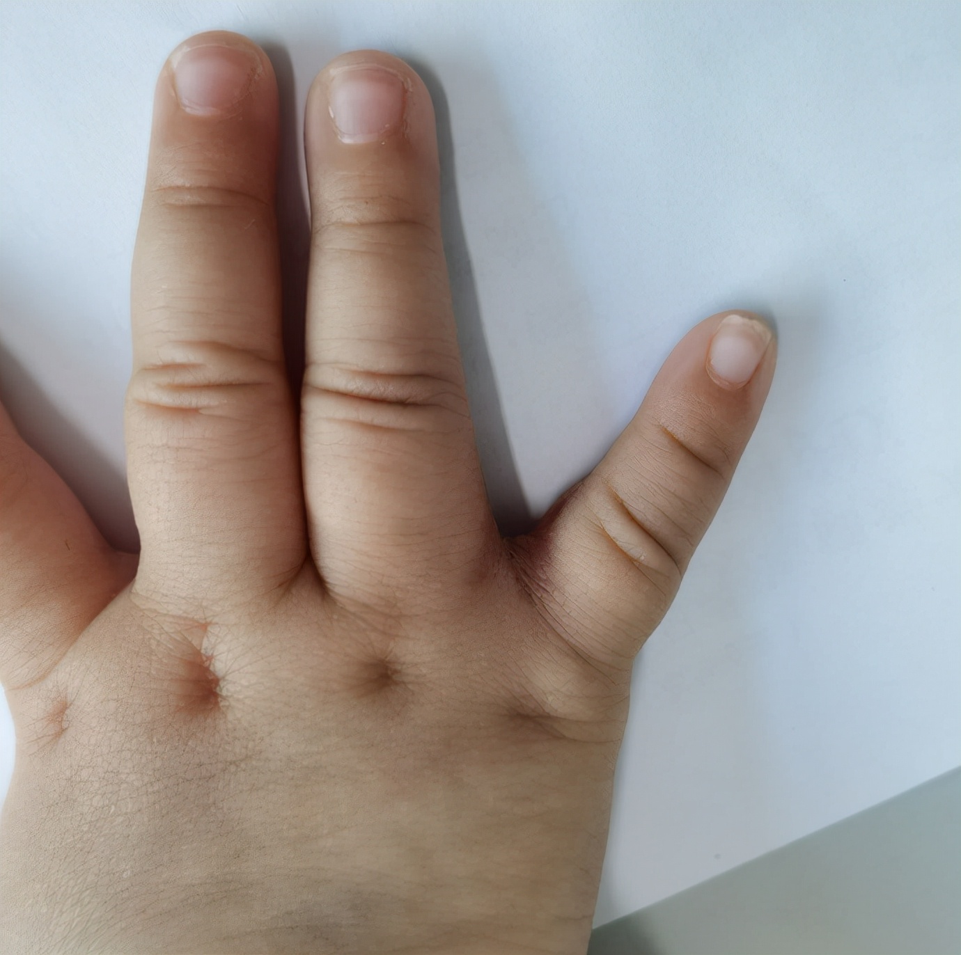 并指畸形免植皮案例,并指畸形