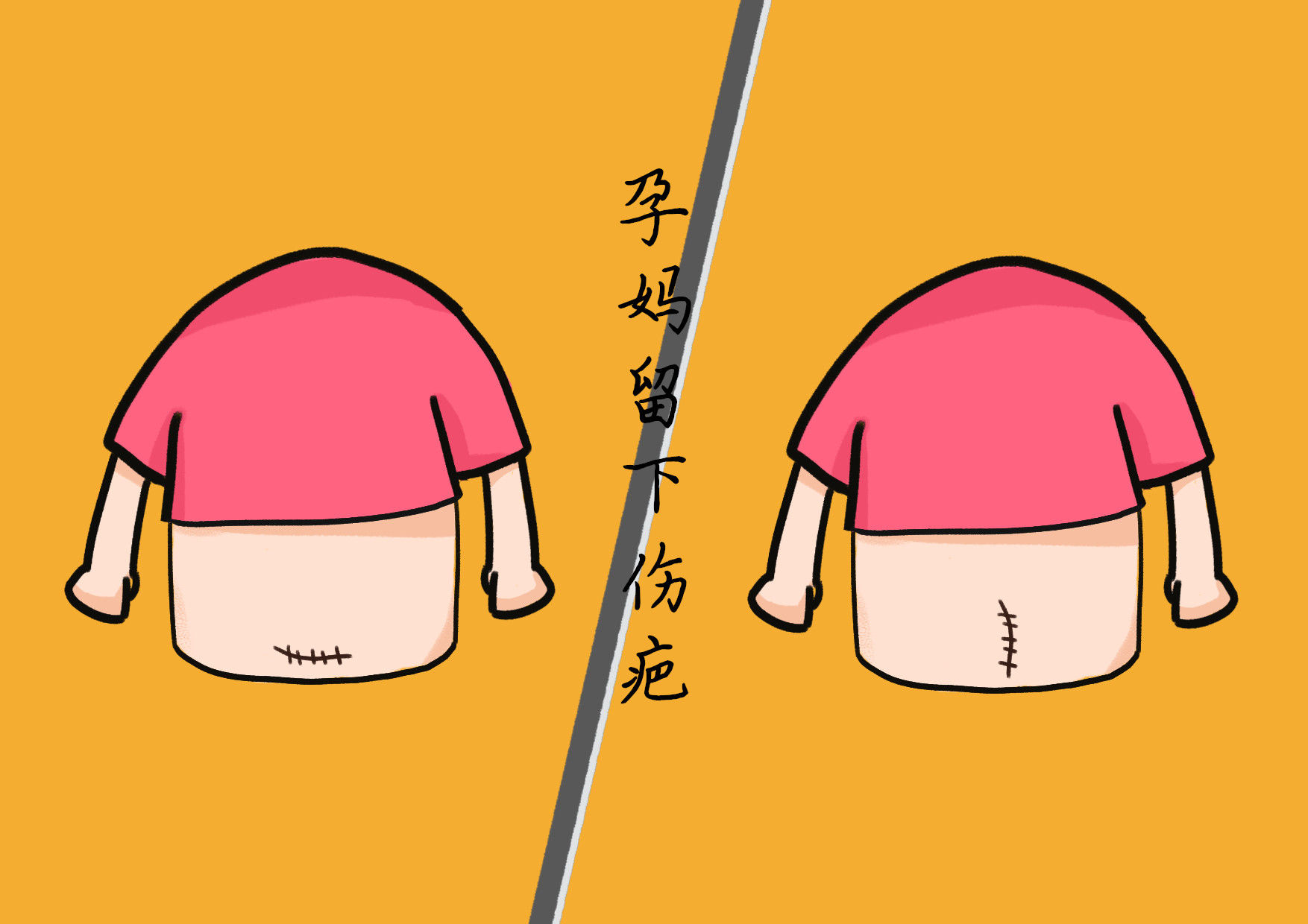 为啥越来越多医院愈发不提倡剖腹产？这些影响不可忽视，孕妈必知