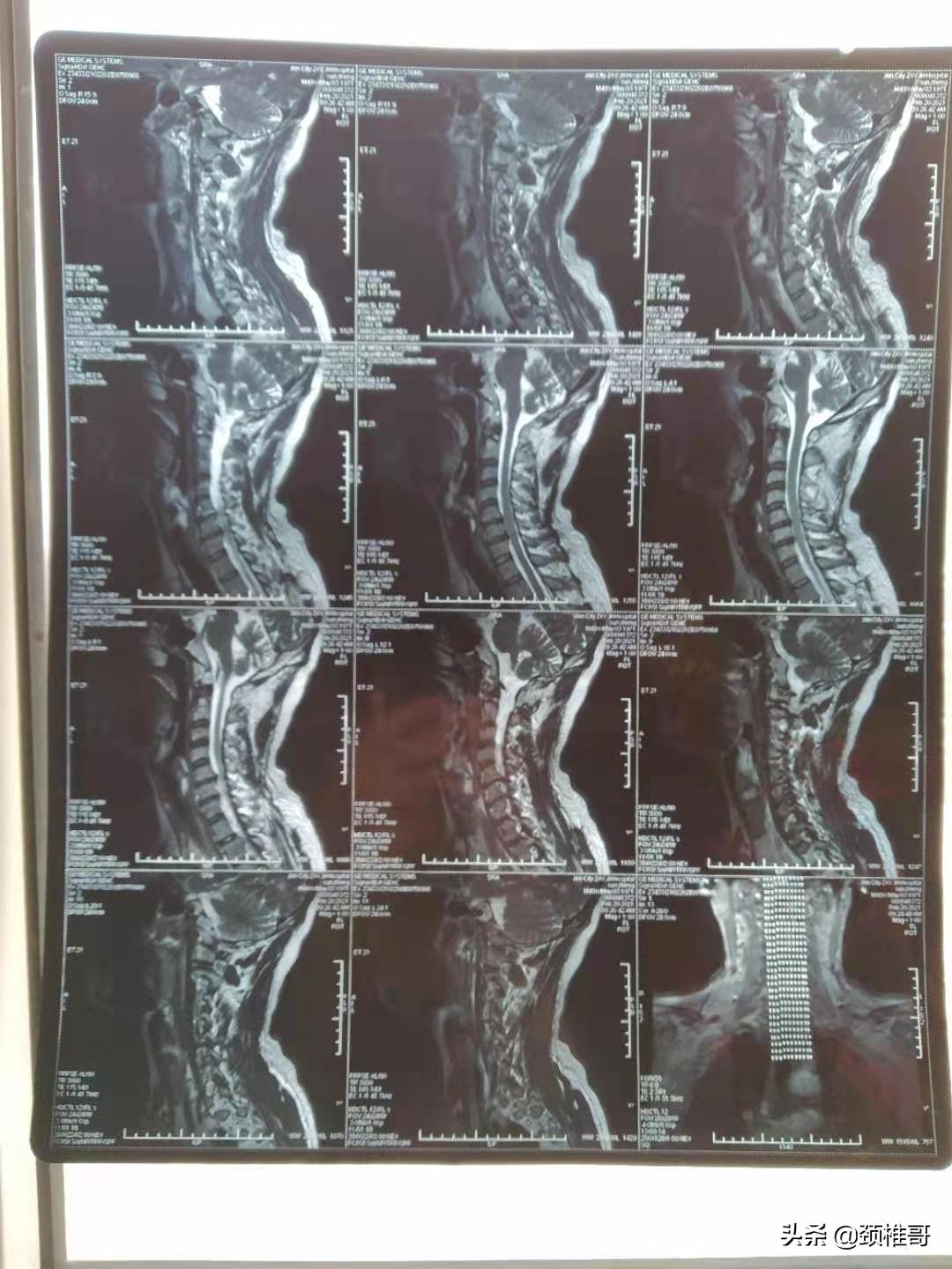 打篮球被撞胸口动一下就疼没有肿,打篮球被撞得锁骨一边疼