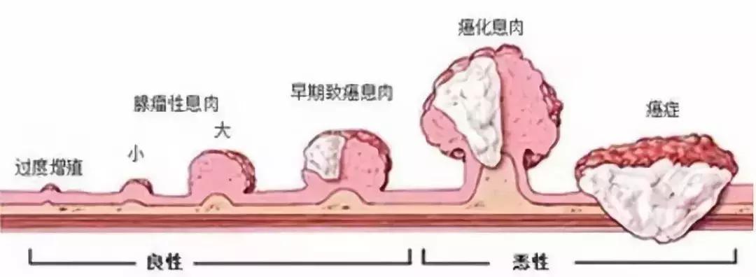 我叫“息肉”，很容易变癌，但是我最怕艾灸