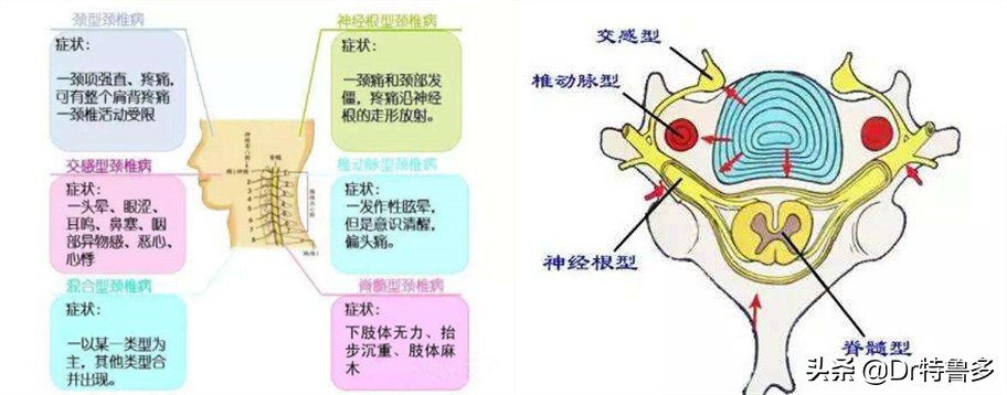 头痛头晕恶心想吐颈椎疼怎么回事,头痛头晕伴有恶心是什么原因