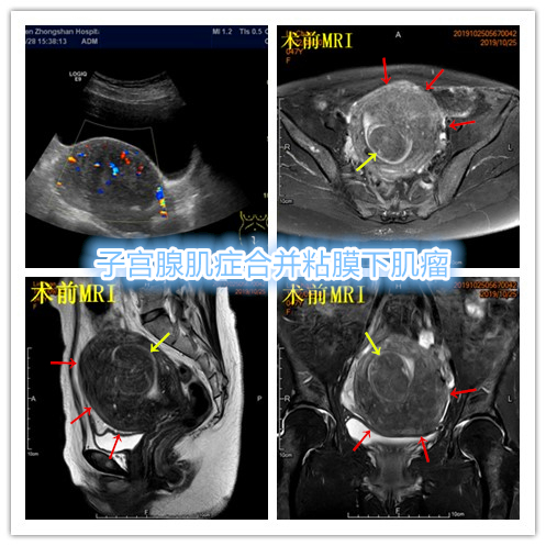 子宫腺肌症介入栓塞全国哪里好,子宫腺肌症介入栓塞治疗报销吗