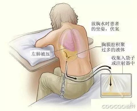 恶性肺癌治疗最佳方案,不幸患上了肺癌怎么发圈求救