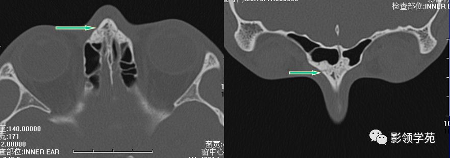 鼻骨骨折的检查方法,鼻骨骨折影像学表现